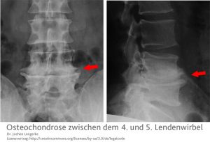MRT-Darstellung einer Osteochondrose der Lendenwirbelsäule